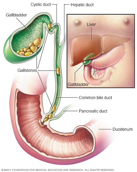What Food Can Cause A Gallbladder Attack What Food Can Cause A Gallbladder Attack